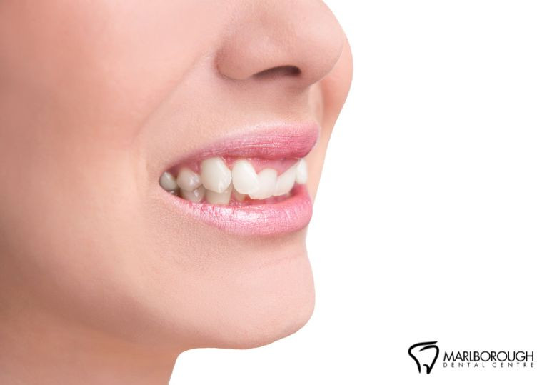 Can Veneers Fix Crooked Teeth? Addressing Mild Misalignment with Veneers
